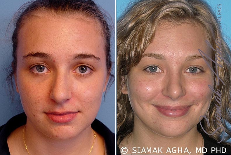 Rhinoplasty Before & After