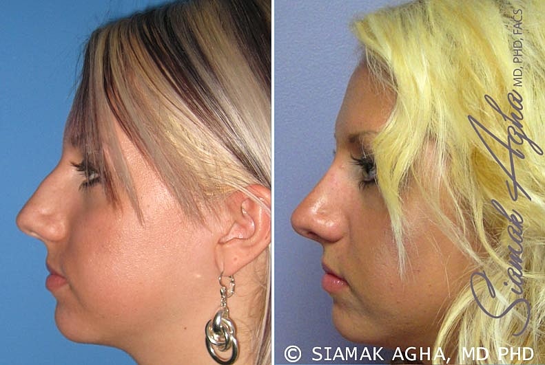 Rhinoplasty Before & After