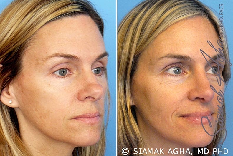 Rhinoplasty Before & After