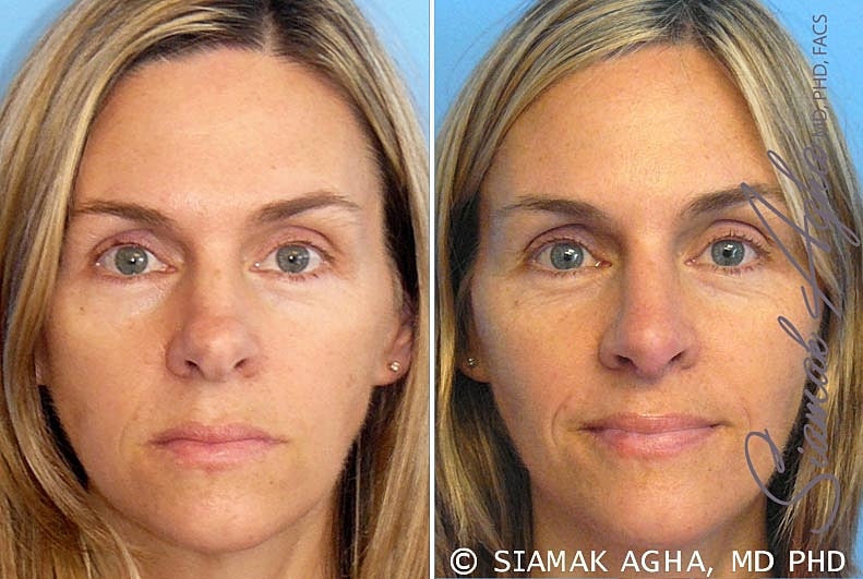 Rhinoplasty Before & After