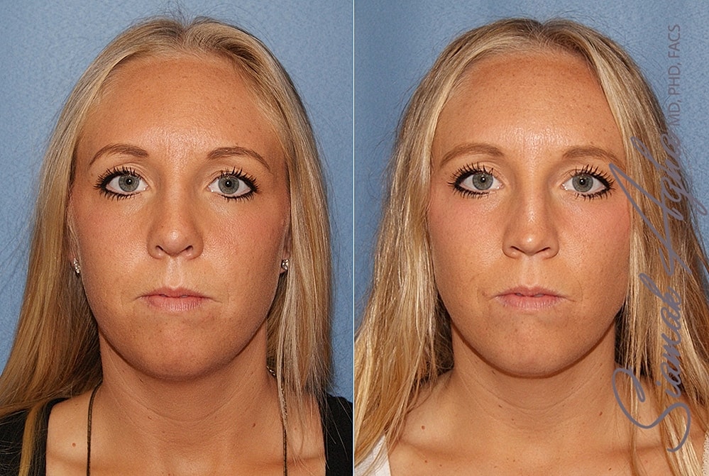 Rhinoplasty Before & After