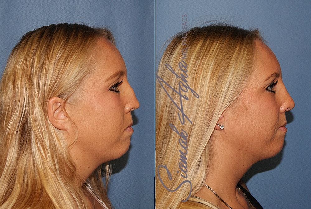 Rhinoplasty Before & After