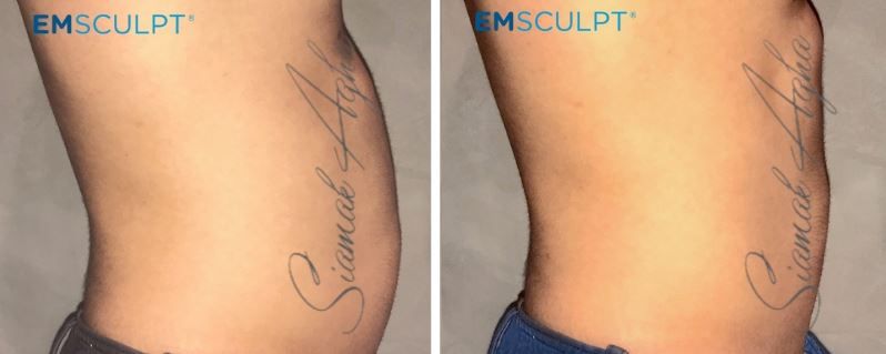 Emsculpt Before & After
