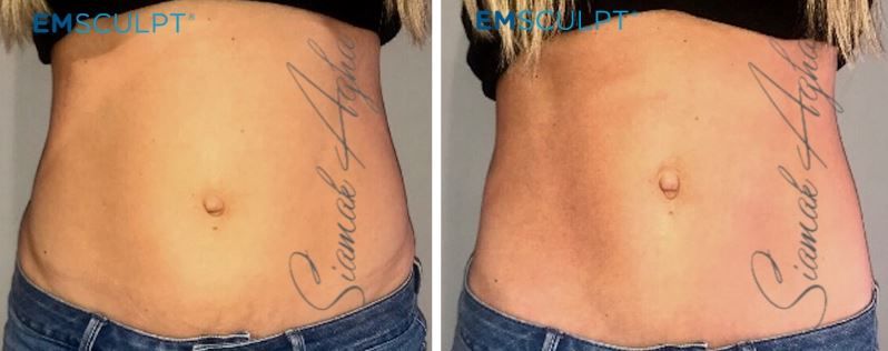 Emsculpt Before & After