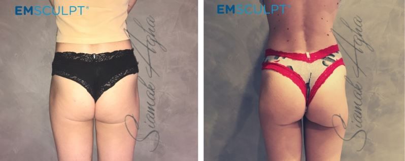 Emsculpt Before & After