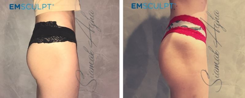 Emsculpt Before & After