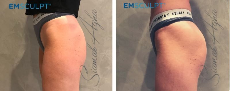 Emsculpt Before & After