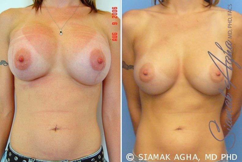 Breast Augmentation Revision Before & After