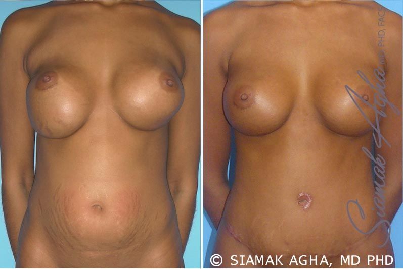 Breast Augmentation Revision Before & After