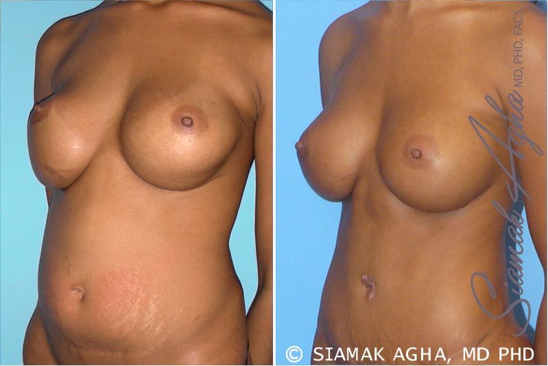 Breast Augmentation Revision Before & After