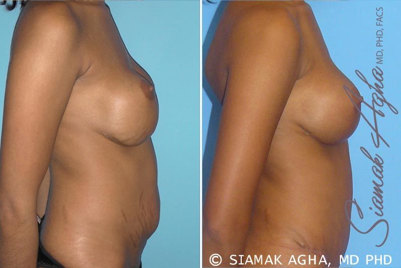 Breast Augmentation Revision Before & After