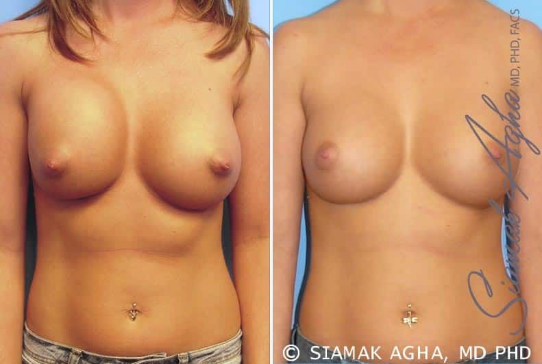 Breast Augmentation Revision Before & After