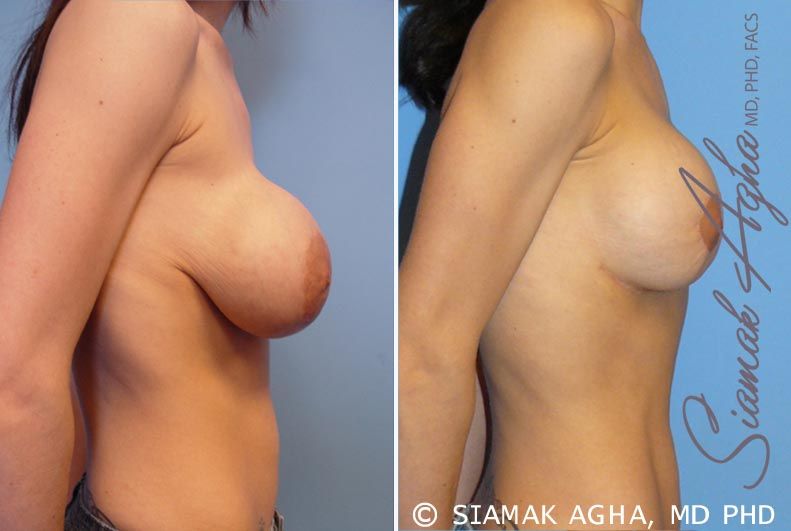 Breast Augmentation Revision Before & After