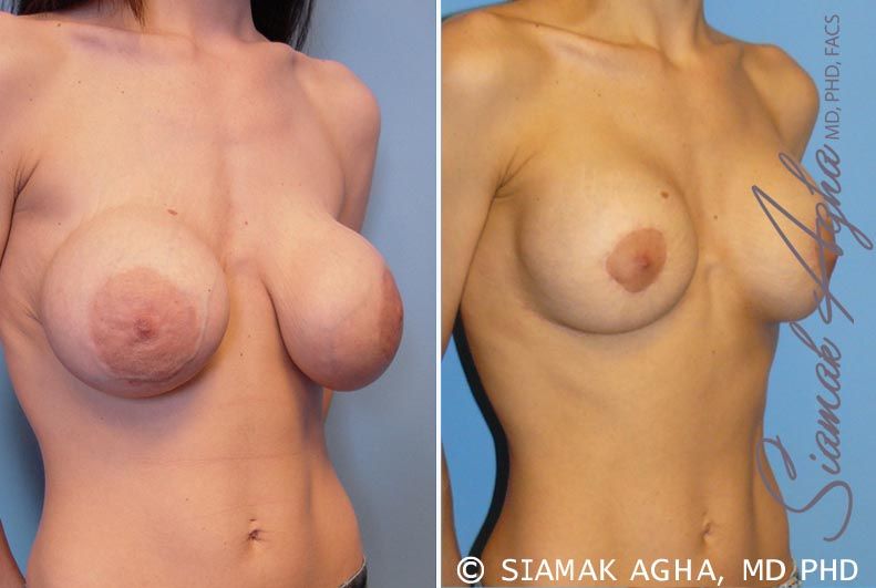 Breast Augmentation Revision Before & After