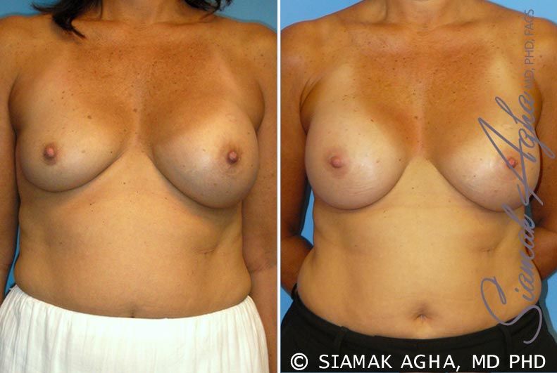 Breast Augmentation Revision Before & After