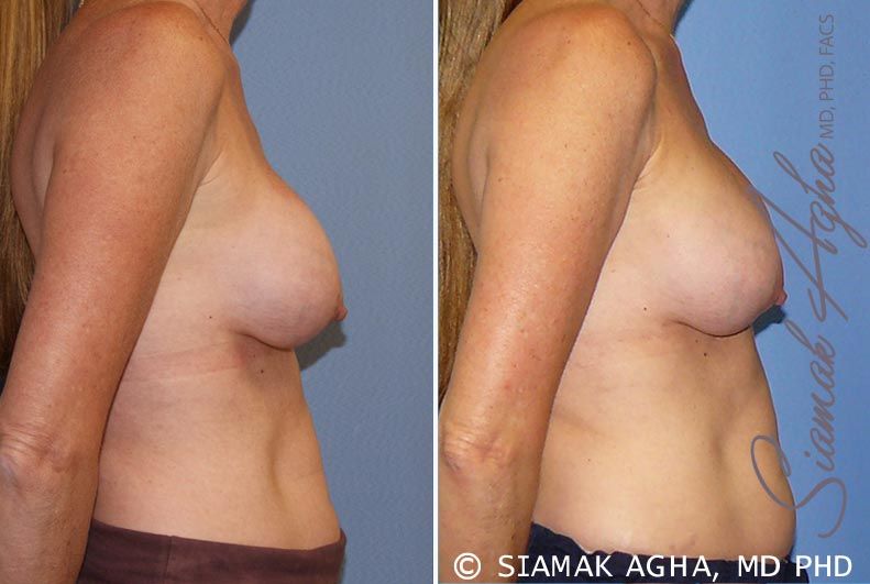Breast Augmentation Revision Before & After