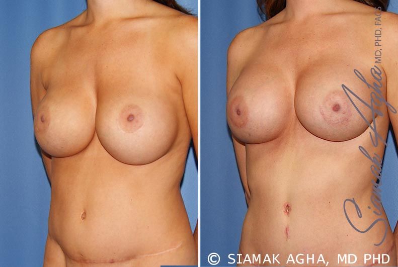 Breast Augmentation Revision Before & After
