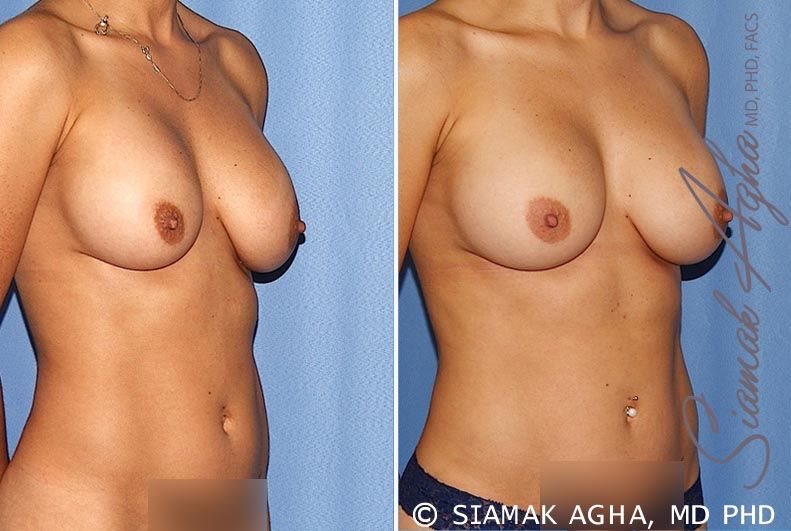 Breast Augmentation Revision Before & After