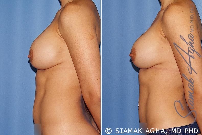 Breast Augmentation Revision Before & After