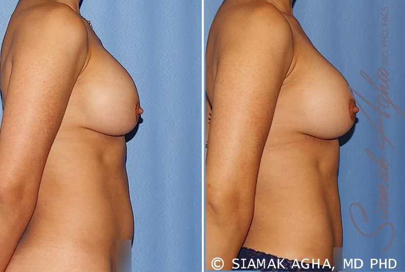 Breast Augmentation Revision Before & After