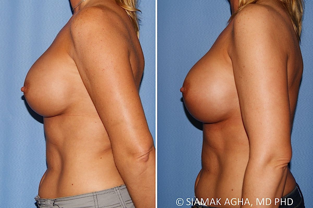 Breast Augmentation Revision Before & After