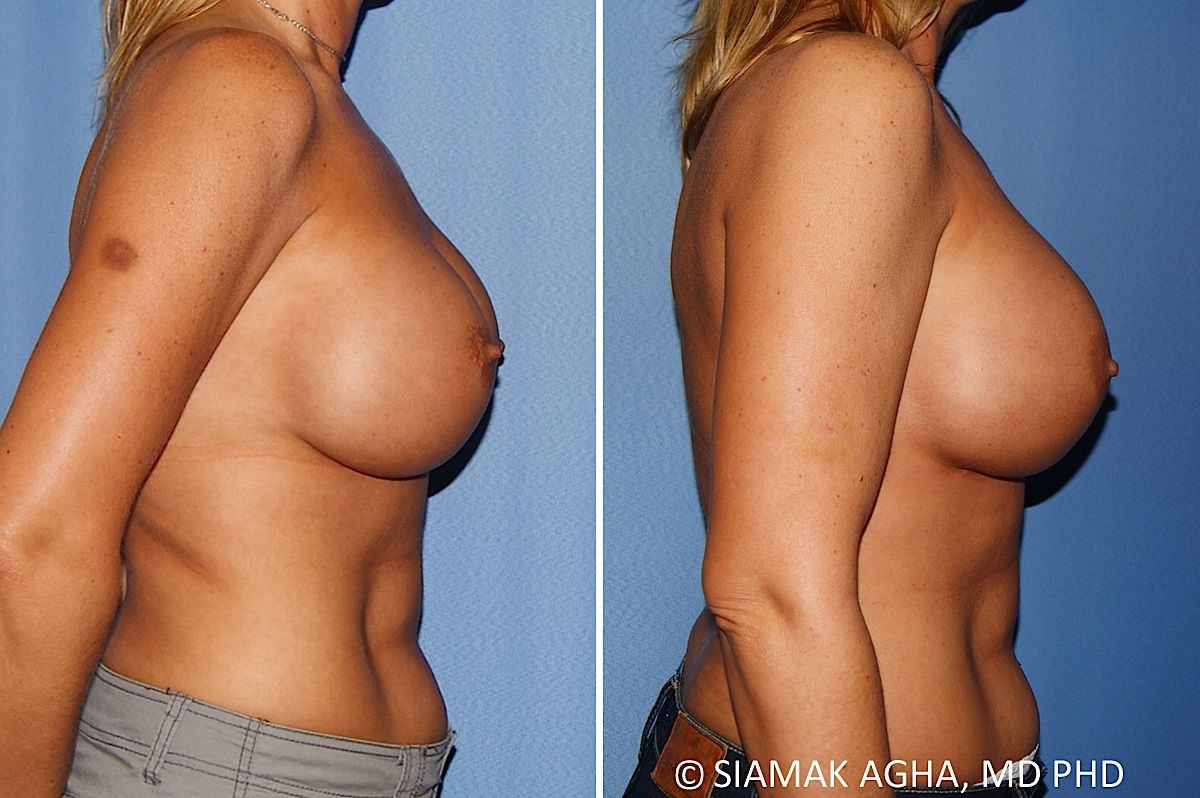Breast Augmentation Revision Before & After