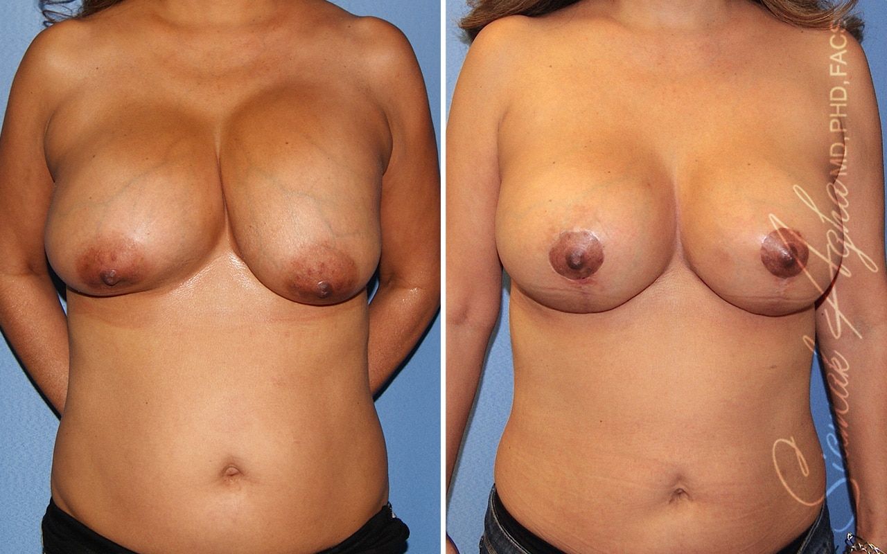 Breast Augmentation Revision Before & After