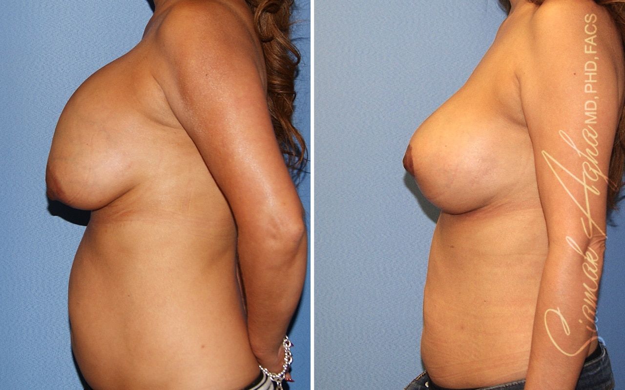 Breast Augmentation Revision Before & After