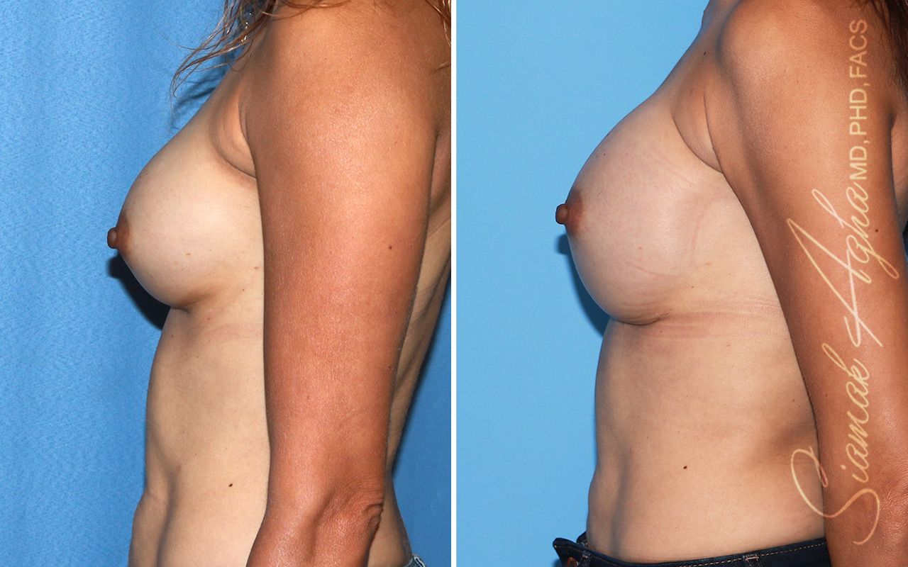 Breast Augmentation Revision Before & After