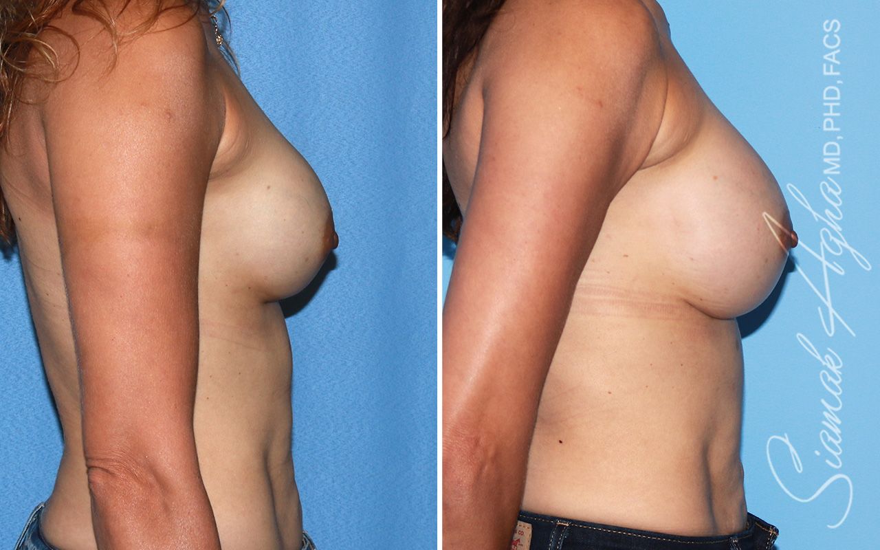 Breast Augmentation Revision Before & After