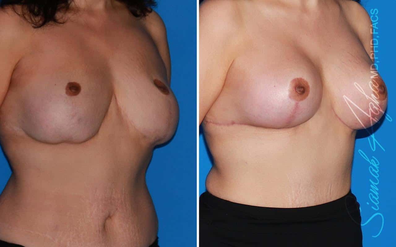 Breast Augmentation Revision Before & After