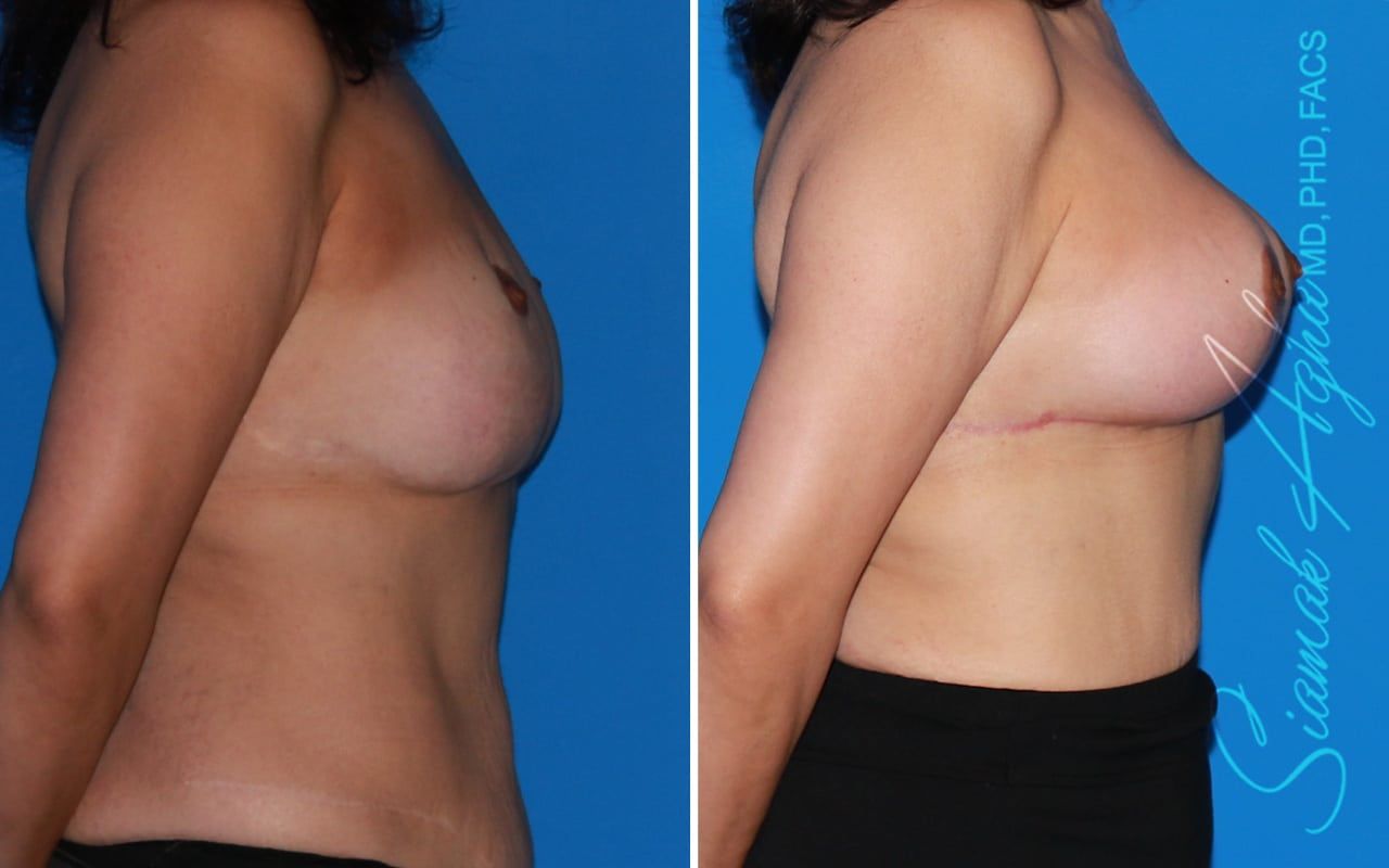 Breast Augmentation Revision Before & After