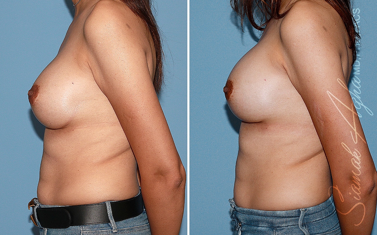 Breast Augmentation Revision Before & After