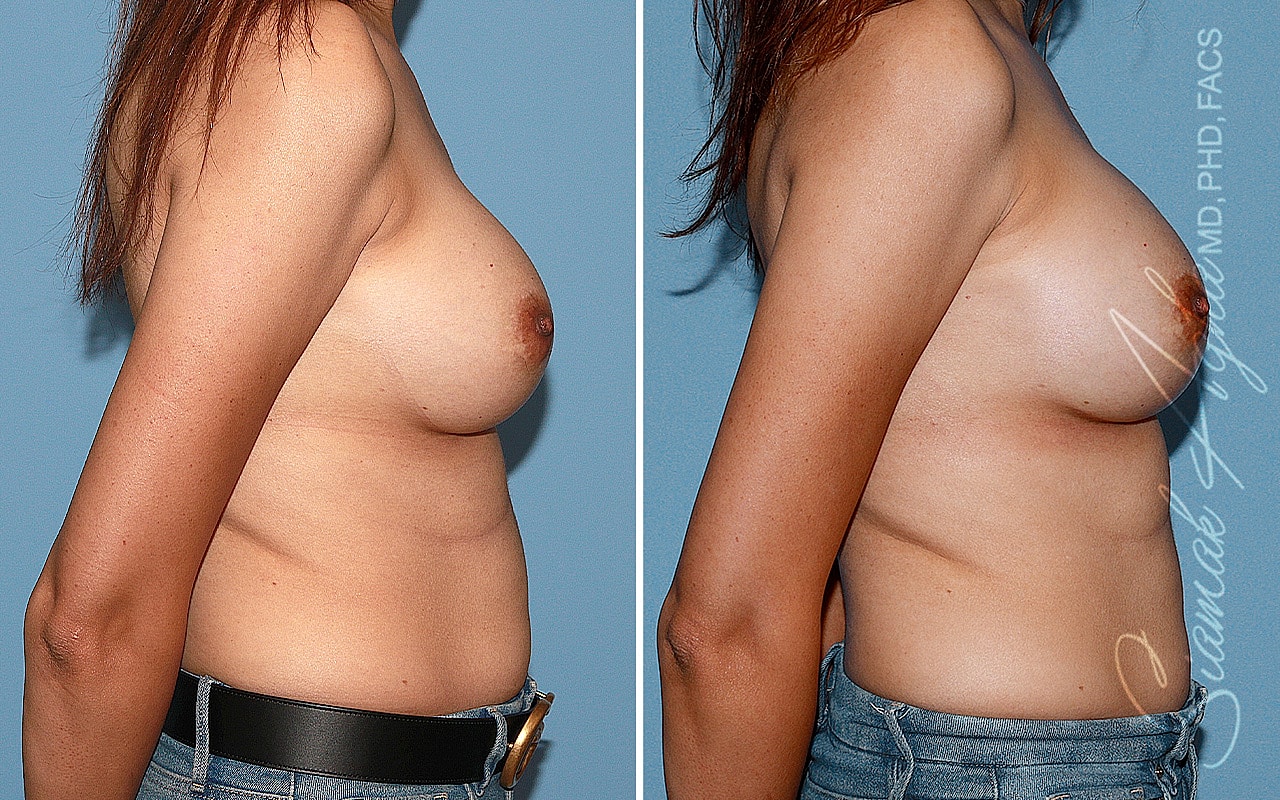Breast Augmentation Revision Before & After