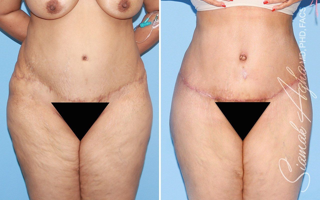Tummy Tuck With Thigh Lift Before & After