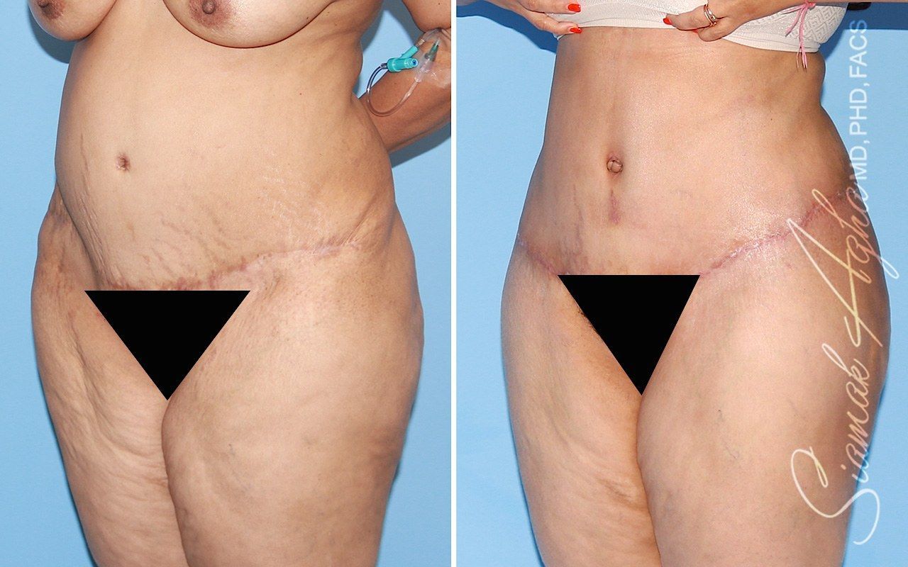 Tummy Tuck With Thigh Lift Before & After
