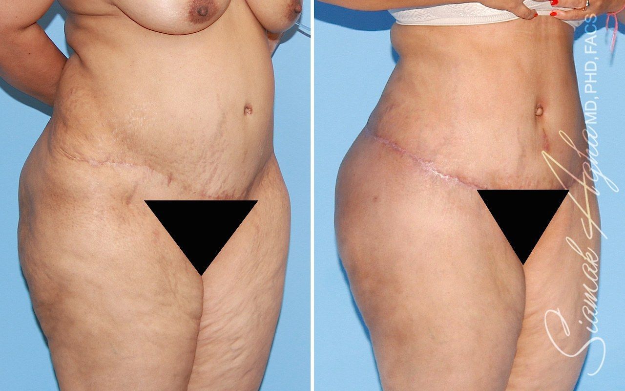 Tummy Tuck With Thigh Lift Before & After