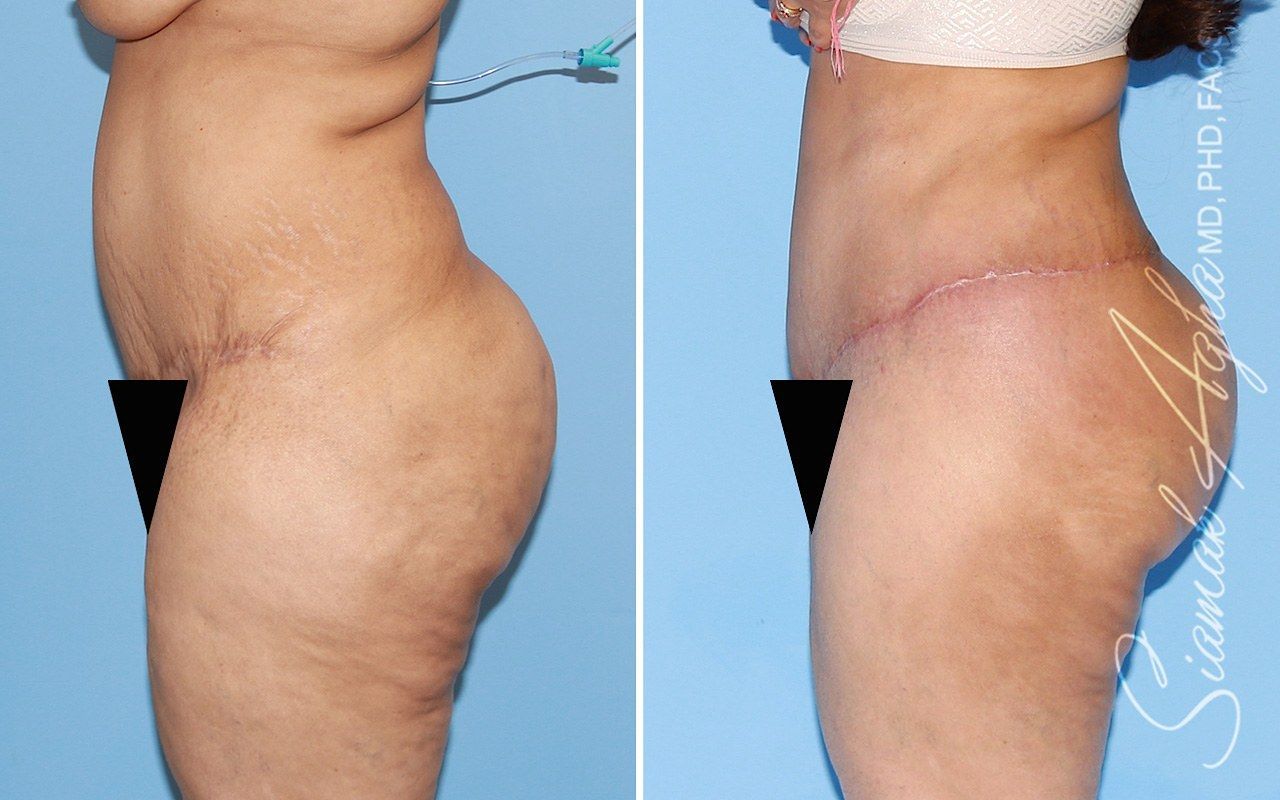 Tummy Tuck With Thigh Lift Before & After