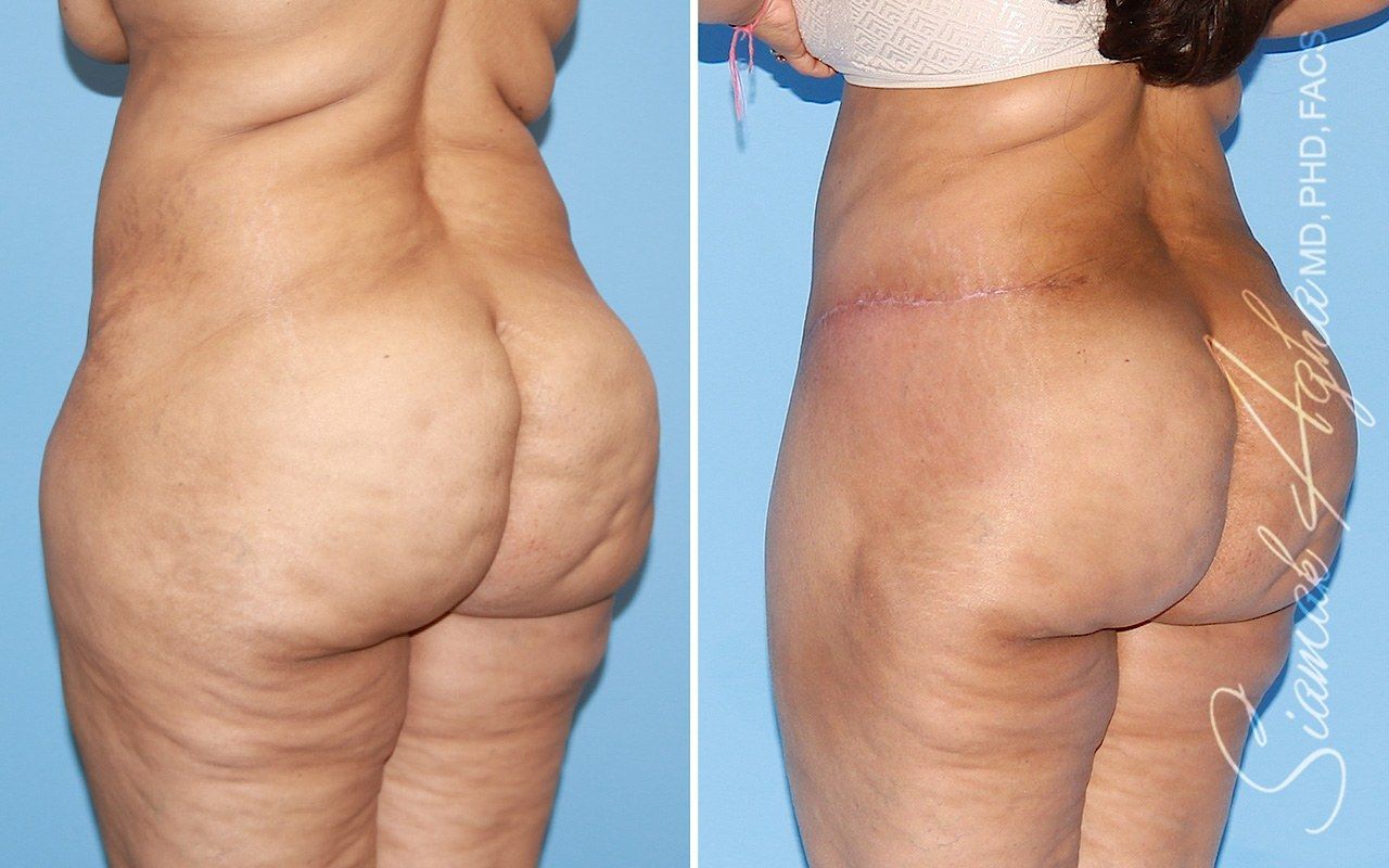 Tummy Tuck With Thigh Lift Before & After