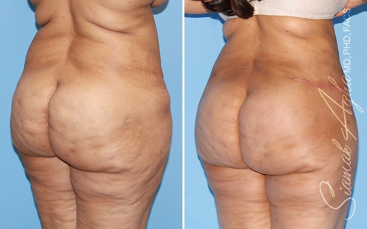 Tummy Tuck With Thigh Lift Before & After