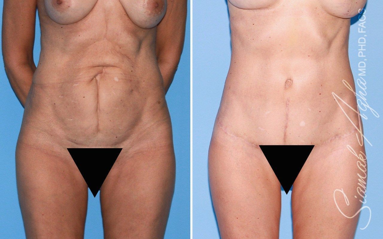 Tummy Tuck With Thigh Lift Before & After