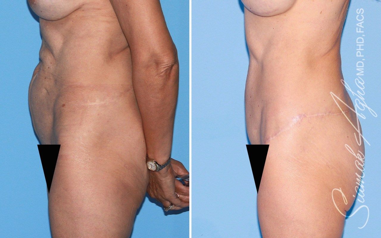 Tummy Tuck With Thigh Lift Before & After