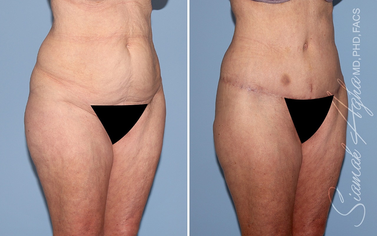 Tummy Tuck With Thigh Lift Before & After