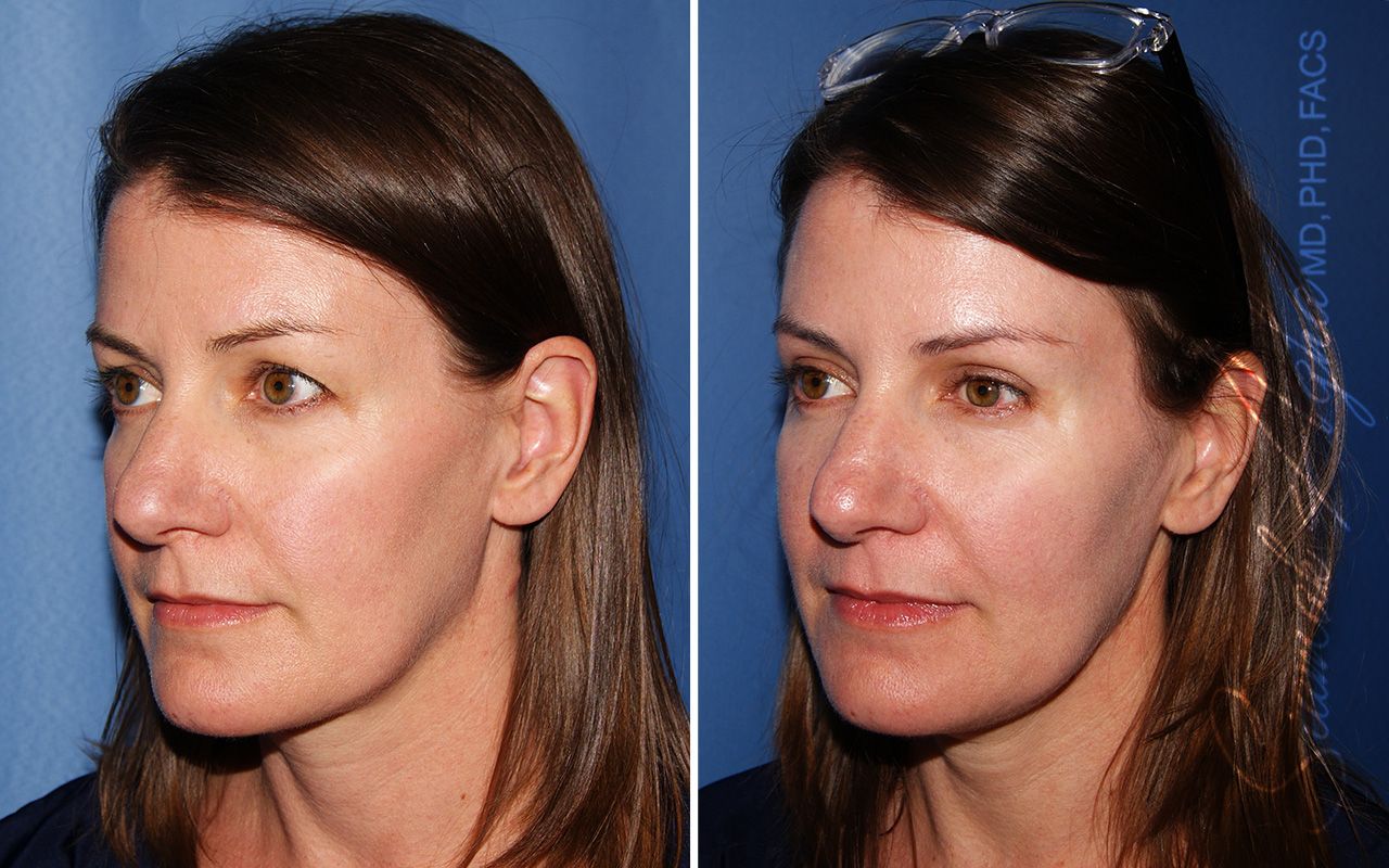 Blepharoplasty Before & After