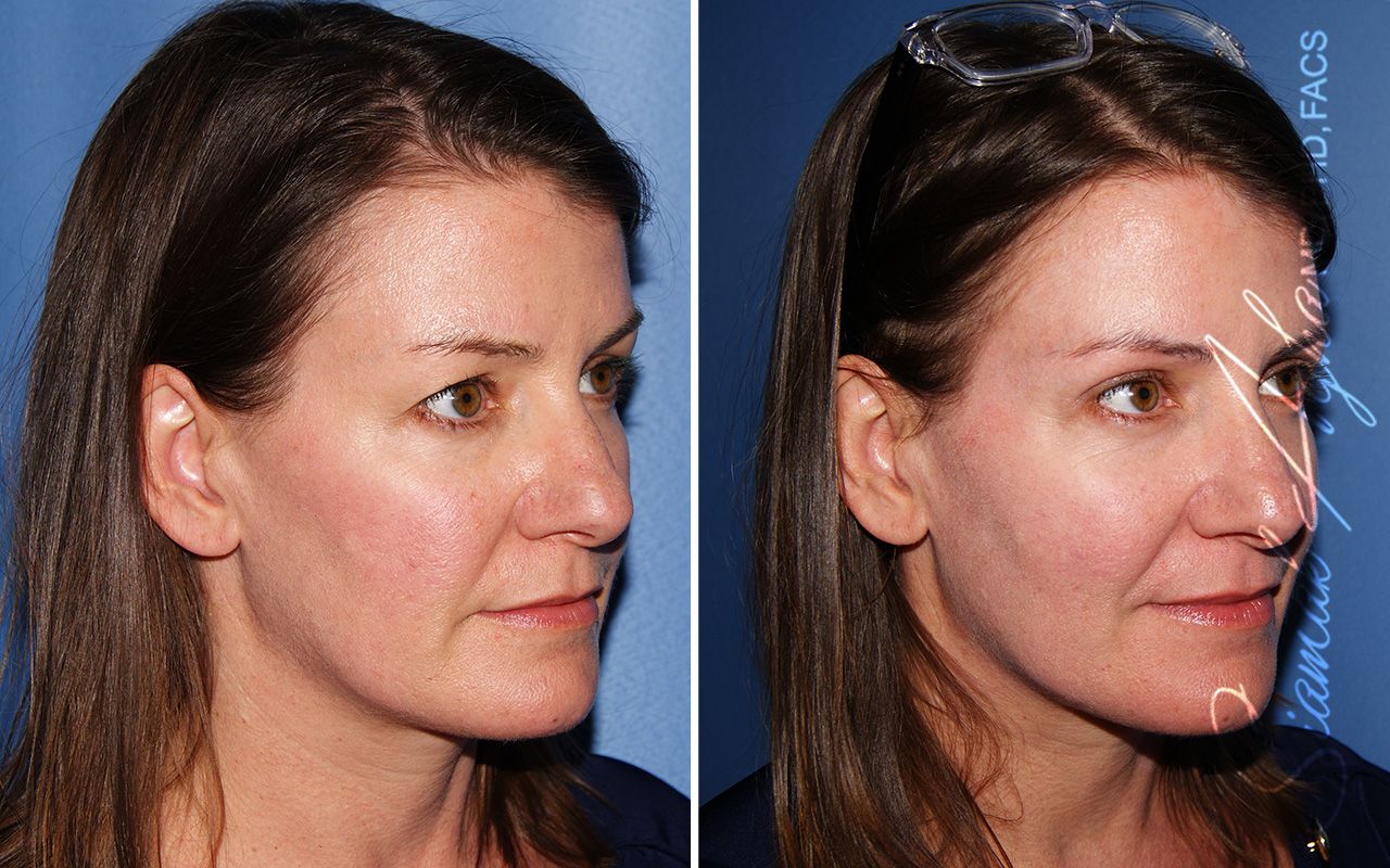 Blepharoplasty Before & After