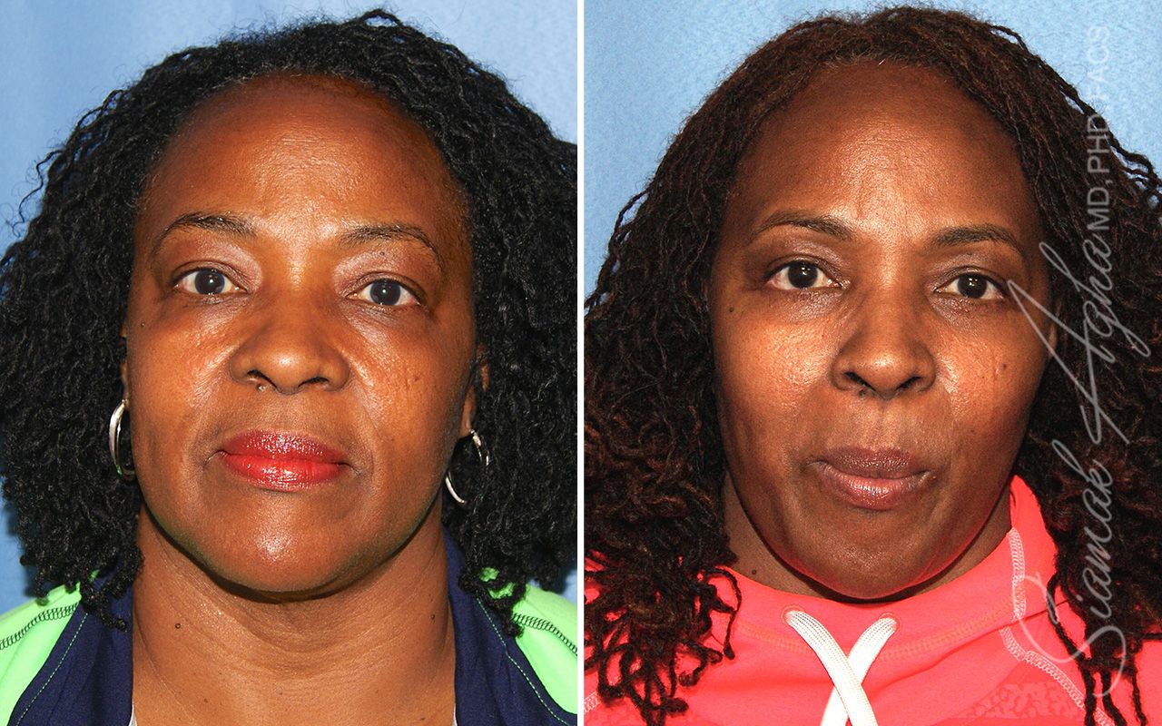 Blepharoplasty Before & After