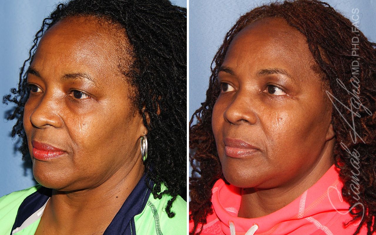Blepharoplasty Before & After
