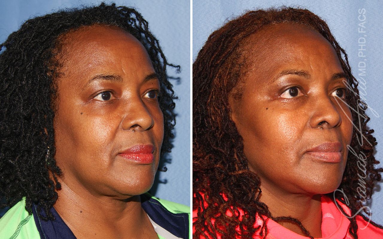 Blepharoplasty Before & After
