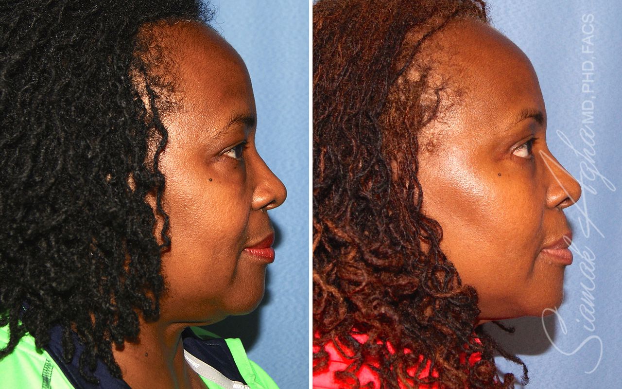 Blepharoplasty Before & After