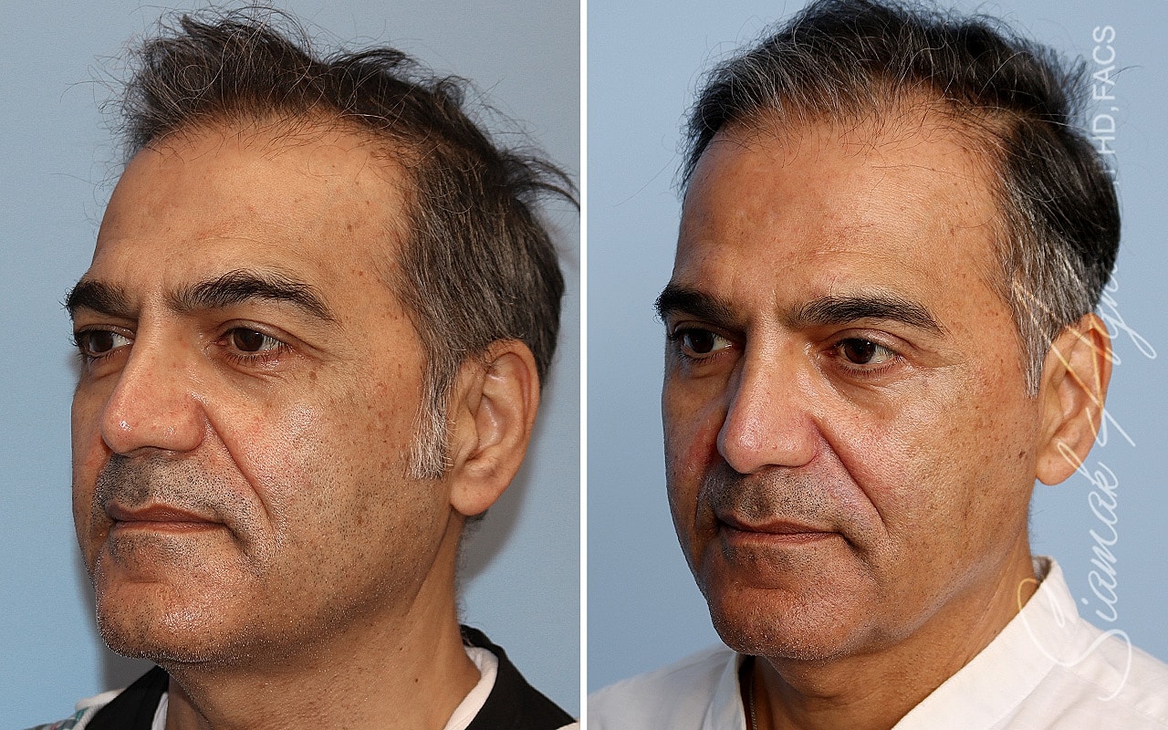 Blepharoplasty Before & After